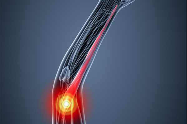 Brachioradialis 