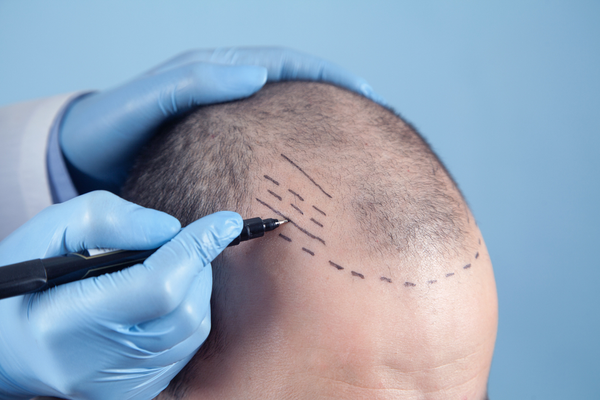 FUE hair transplants