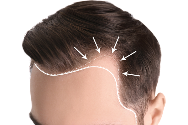 FUE hair transplant
