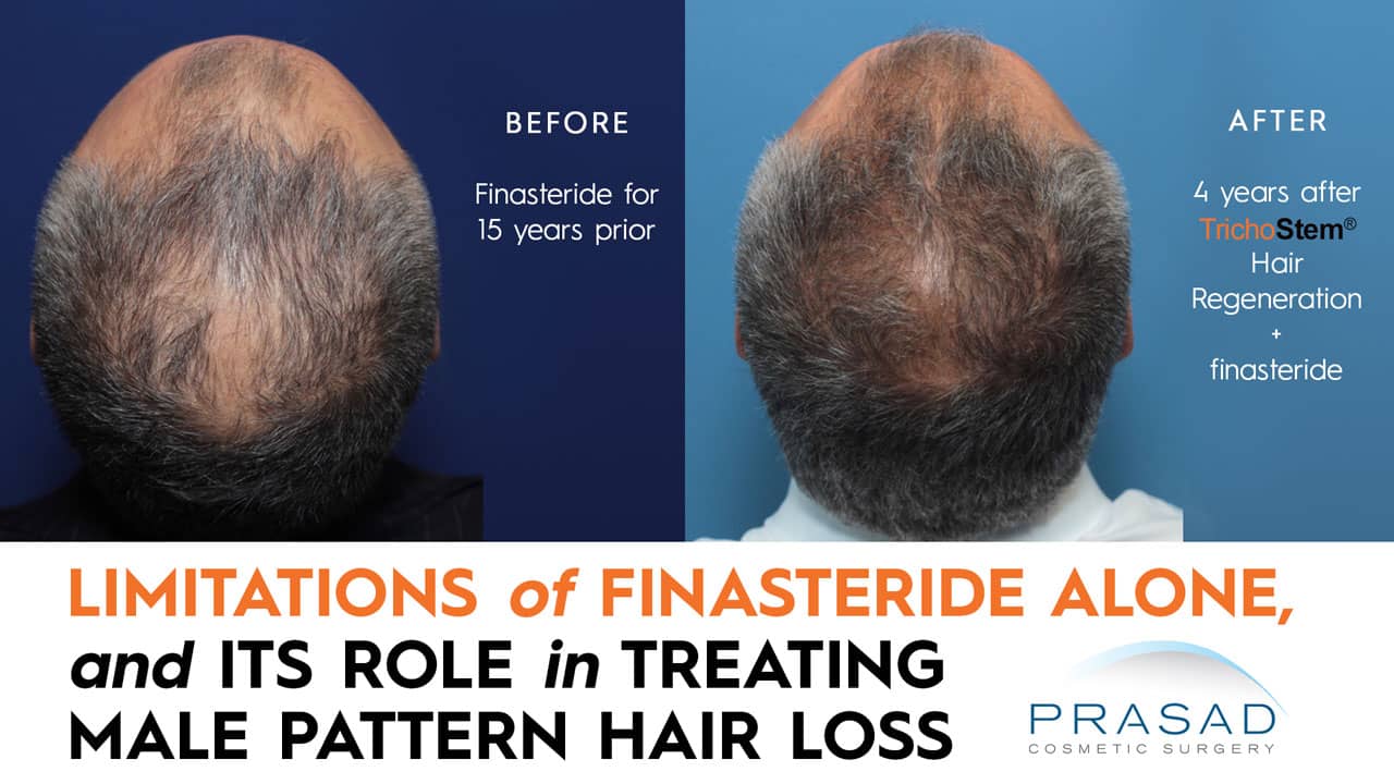 hair loss treatment